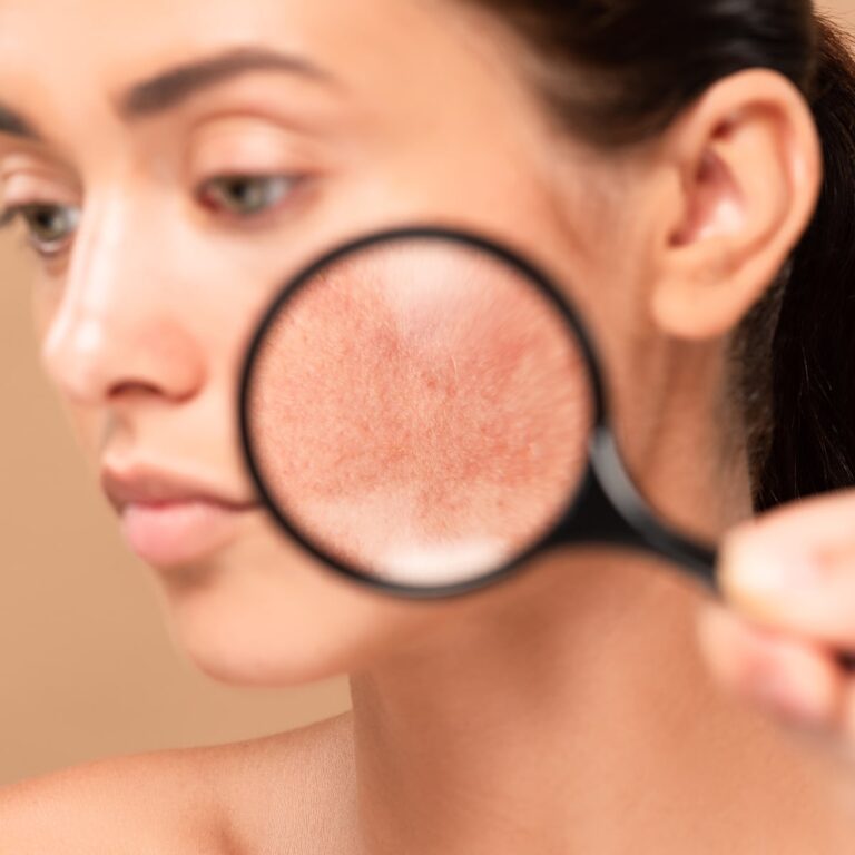 Rosacea in het gezicht